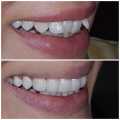 Alat untuk merapihkan gigi maju Alat perapih gigi tonggos original asli Perapih gigi maju ke depan Behel gigi lepas pasang karet murah Perapih gigi tonggos atas asli ginsul atas tidak rata asli Alat buat merapihkan gigi tonggos Teeth Trainer Alignment ORI. 