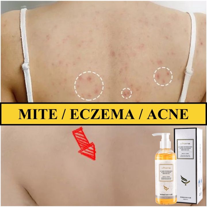 AntiAcne Body Wash Whitening Body lotion 260ml body acne body wash