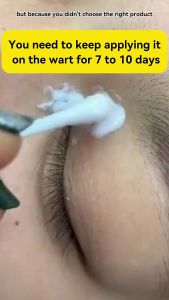 Muyuan~Warts removal cream ubat kutil buang tahi lalat dan biji kolestrol Skin Tag Remover Mole repellent painless effective