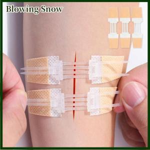 Blowing Dây kéo Band-Aid không đau vết thương đóng cửa vá vết thương không khâu mặc quần áo các bản vá lỗi Zip khâu Reducer ban nhạc viện trợ ngoài trời di động