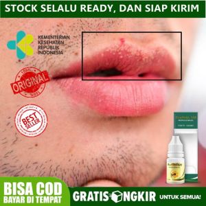 Obat Penghilang Bintik Bintik Putih di Bibir Fordyce Spots / Bintik Putih di Bibir Pengempis Bintik Melepuh Berukuran Kecil Obat Penghilang Herpes Labialis di Mulut / Bibir Menghilangkan Bintik di Bibir Berwarna Hitam Agar Pada Merah Alami
