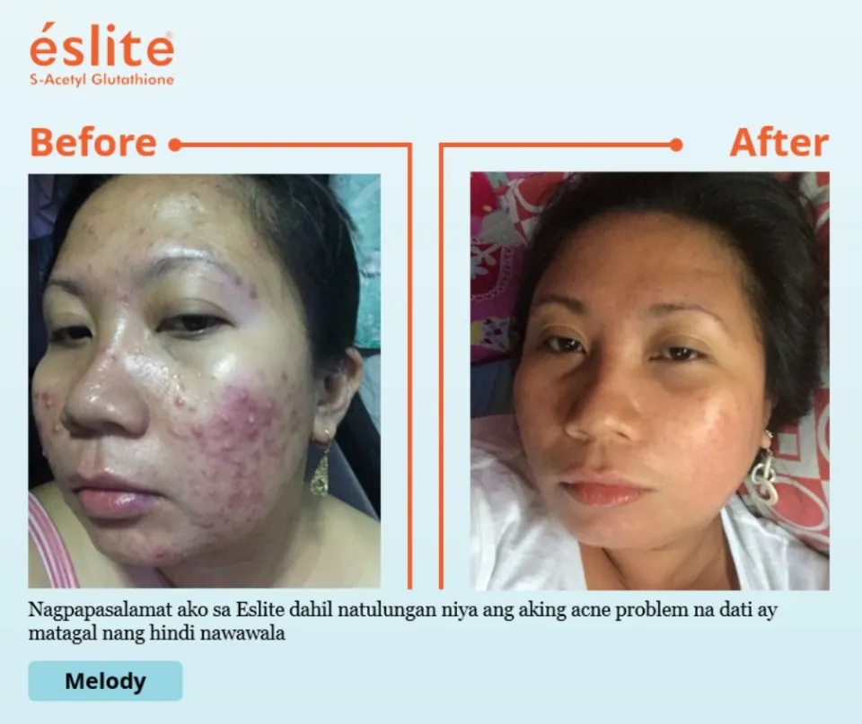 Eslite S-Acetyl Glutathione Anti Aging & Antioxidant & Whitening Skin &  Liver Protection Enhance Immunity 60 Capsule