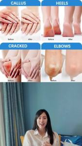 Urea Cream 40 percent for Feet Maximum Strength + 2% Salicylic Acid Exfoliating Dead Skin & Soften Crack Foot for Extremely Dry Skin Body Lotion Urea 40% Cream Enriched Skin Moisturizer 5.3 oz(40%)