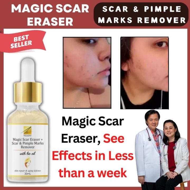 Pimple marks remover discount
