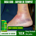 Obat Cedera Engkel, Nyeri Pergelangan Kaki, Ankle Sprain, Keseleo, Kaki Terkilir, Kaki Bengkak, Luka Memar, Patah Tulang, Obat Untuk Cedera Ankle, dgn Minyak Sapu Jagat DI URUT. 