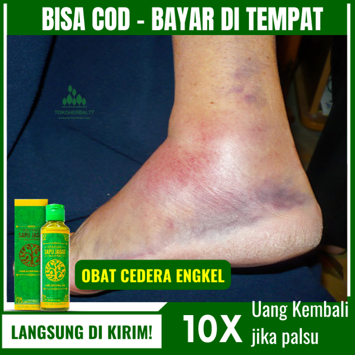 Obat Cedera Engkel, Nyeri Pergelangan Kaki, Ankle Sprain, Keseleo, Kaki Terkilir, Kaki Bengkak, Luka Memar, Patah Tulang, Obat Untuk Cedera Ankle, dgn Minyak Sapu Jagat DI URUT