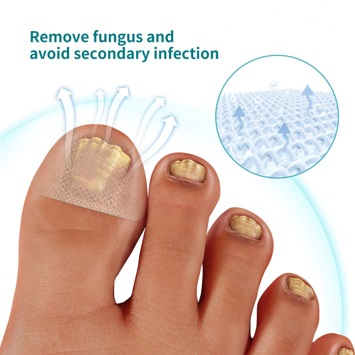 %E3%80%90100%25%20Effective%E3%80%91Jaysuing%20Fungal%20Nail%20Treatment%20Patch%20Anti%20Infection%20Paronychia%20Thickening%20Soft%20Waterproof%2032pcs%20-%20Image%204
