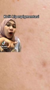 LACOCO ANTI FLEK - LACOCO DARKSPOT - ATASI FLEK HITAM - BEBAS JERAWAT ORIGINAL - LACOCO ANTI FLEK