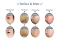 IPL Ice Point Yag Laser IPL And ND Yag Laser Hair Remove Skin Rejuvenation Ance Treatment Laser Picosecond. 