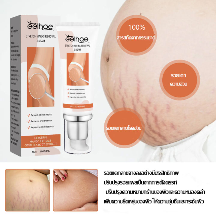 ครีมรอยแตกลาย ครีมทาขาแตกลาย ครีมลดรอยแตกลาย ลดรอยแตกลาย ทา7วันหาย รอย ...