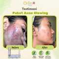 Orlin Beauty Paket Acne Glowing Platinum 4in1 Mencerahkan Wajah Kulit Sensitif Bekas Jerawat Flek Hitam Skincare BPOM. 