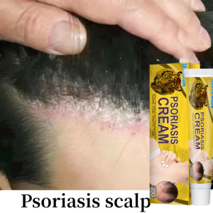 Kem Viêm Da Tiết Bã 20g Bệnh Vẩy Nến Chàm Kháng Nấm Đầu Kem Mụn Ngứa Giảm Da