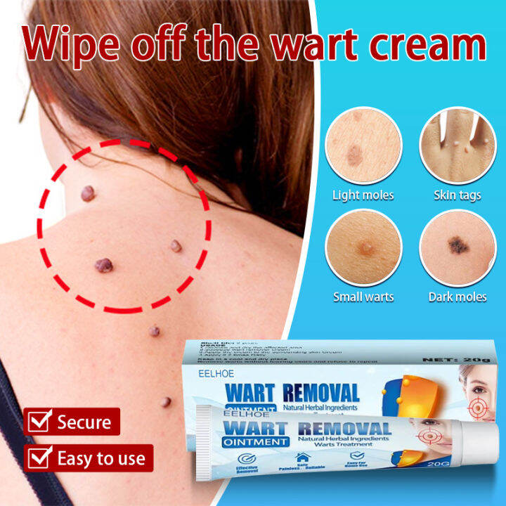 warts remover original watson kasoy oil warts remover legit skin tags ...