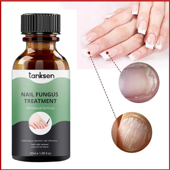 Professional Nail Fungal Cure Nail Fungus Removal Spray Nutritious Anti