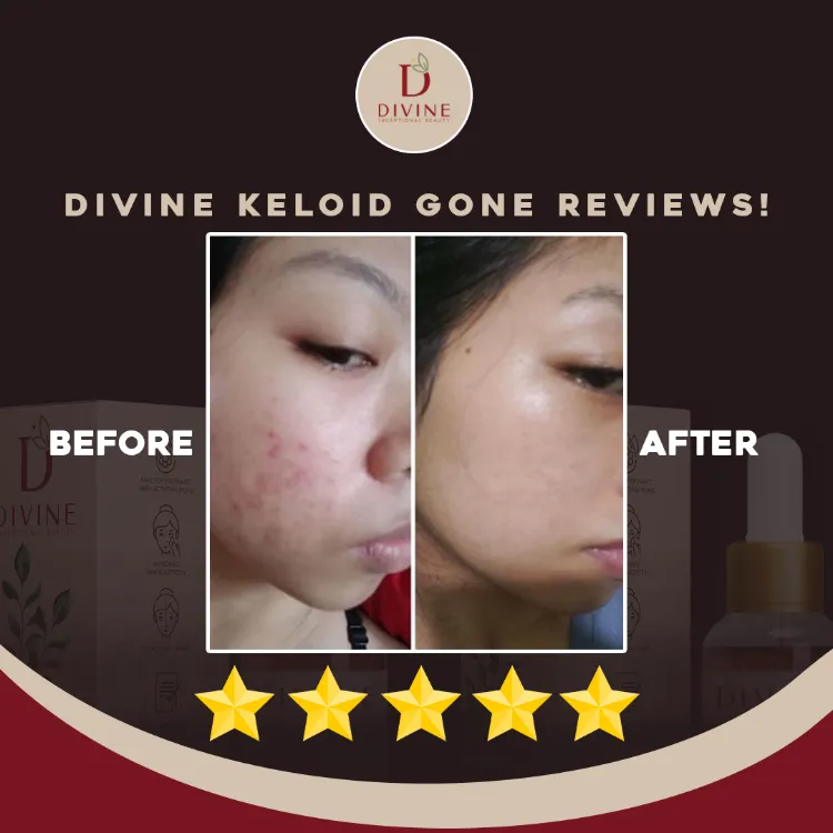 Keloid Gone Scar Remover Original Face Scar Keloid Remover Pimple