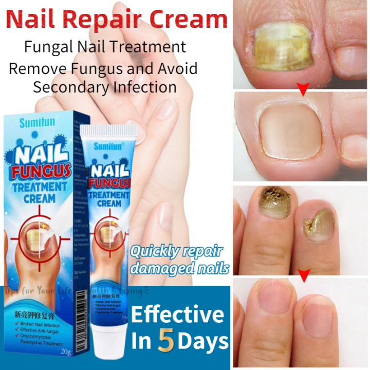 Nail Repair Cream, Effective Toenail Fungal Treatment, Maximum Strength Fungal  Nail Treatment, Restores The Healthy Appearance : Amazon.co.uk: Beauty