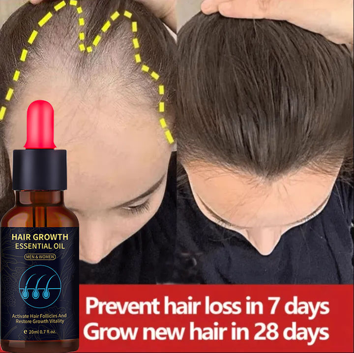 Minoxidil 5% Hair Grower Serum Original Hair Growth Minoxidil Hair ...