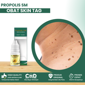 Obat Penghilang Skin Tag Obat Daging Tumbuh Obat Skin Tag Remover Obat Pengelupas Benjolan Kecil Obat Daging Jadi Menahun Pengempis Papiloma Obat Daging Tumbuh Di Kulit Dengan Propolis SM
