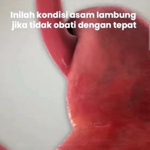 bebas mag Madu Herbal 3x Lebih efektif atasi asam lambung maag