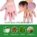 gamot sa kati kati sa balat skin fighter atoderma cream original ointments and creams eczema treatment dermacare cream for psoriasis skin deases antibacterial cream. 