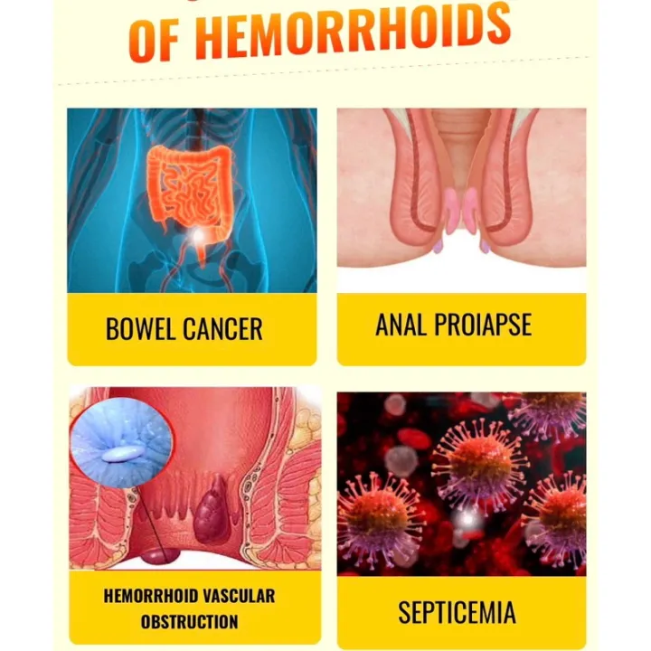 Nano%20Tri%20Hemorrhoid%20Relief%20-%20Sale%20Price%20-%20Buy%202%20Get%201%20Free%20-%20Instant%20Comfort%20and%20Healing%20-%20Image%206