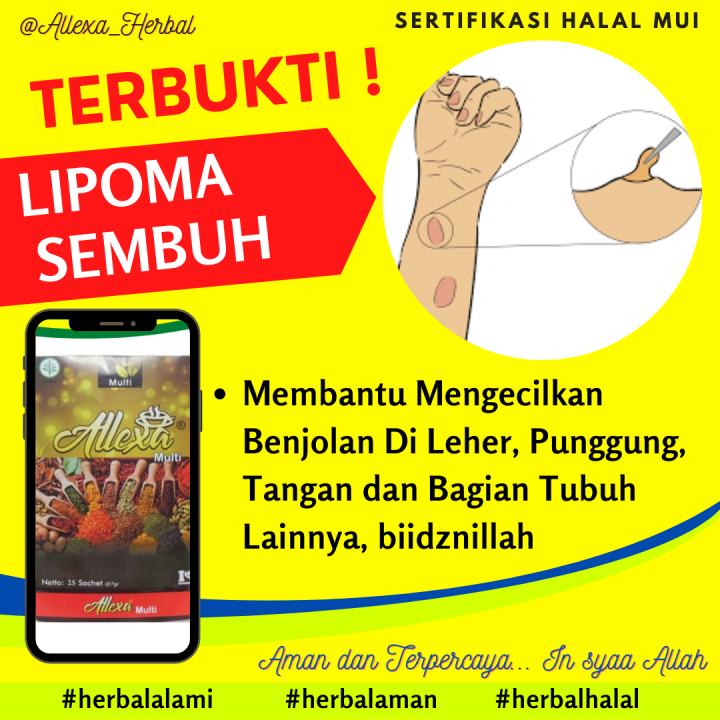 Obat benjolan lemak (Lipoma) Benjolan di tangan, Benjolan Di perut, Benjolan Di Ketiak, Obat Lipoma, Herbal Lipoma- Allexa Multy Amazing Herbal Tea