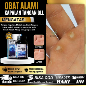 Obat Untuk Kapalan Obat Khusus Untuk Kapalan Obat Oles Penghilang Kapalan Obat Untuk Menghilangkan Kapal Di Tangan Dan Kaki Salep Oles Kapalan Di Kaki Dan Tangan Benjolan Keras Di Kulit Telapak Kaki Kapalan Kulit Kasar Kulit Menebal Propolis SM