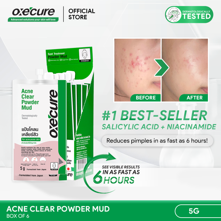 Oxecure 2 Salicylic Acid Acne Clear Powder Mud 5g Box Of 6 Lazada Ph 9783