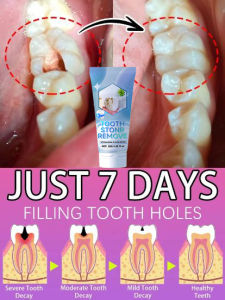 Contains Probiotics to Repair Tooth Decay and Clean Teeth2026