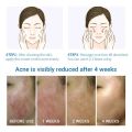 GL.25g Pimple Remover Cream Acne Removal Scar Marks Cream Acne Treatment Skin Cream Effective Anti-acne. 