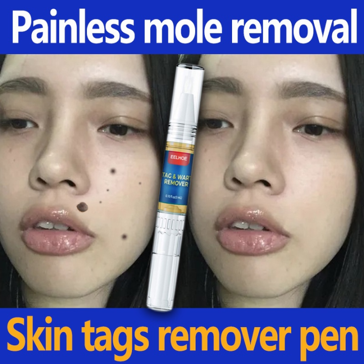 Wart Remover Pen – 5ml – Painless Skin Tag & Mole Eliminator – Herbal Essence – 2 Pack