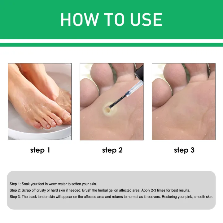 Jaysuing%20Warts%20Remove%20Liquid%20Smooth%20Skin%20Gentle%20Foot%20Care%20Ready%20Stock%20Wholesale%20-%20Image%206