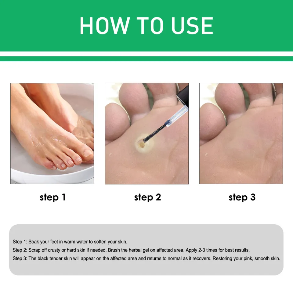 Foot Corn Removal Best Foot Cream For Dry Hard Skin Get Foot Cream