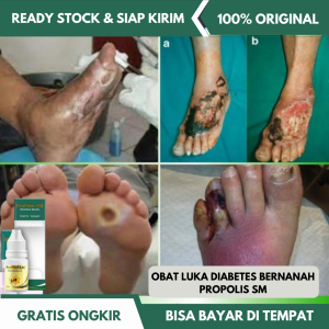 Obat Pengering Luka Diabetes Bernanah - Obat Luka Diabetes Cepat Kering - Luka Diabetes Berbelatung - Luka Diabetes Basah Kering - Borok Diabetes - Luka/kaki diabetik Sembuh Dengan Propolis SM