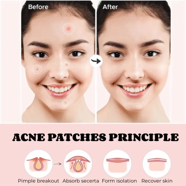 C.three%2036Pcs%20Acne%20Patch%20Salicylic%20Cute%20Star%20Invisible%20Pimple%20Acne%20Remover%20Patch%20Sticker%20SkinCare%20Waterproof%20TOPITEM%F0%9F%91%8D%20-%20Image%207
