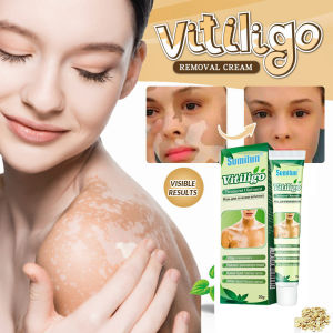 vitiligo treatment cream psoriasis ointment skin white spots pigment melanin mycosis leukoplakia vitiligo homeopathy Regenerating Topical Ointment Krim Kulit Herba Merawat Vitiligo Krim Sapuan Regenerasi Pigmen Pembaikan Tompok Putih