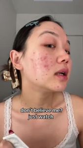 ครีมดูแลปัญหาผิวอักเสบ 345 Relief Cream Dr.Althea 50ml ดร.อัลเทีย  มอยเจอร์ไรเซอร์ จัดการสิวโดยเฉพาะ ผิวแน่นขึ้น อิ่มฟู