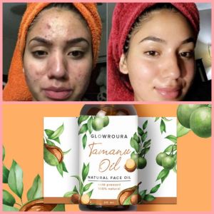 | 100% ORIGINAL !!! | UB SERUM GLOWING PENGHILANG BOPENG BEKAS JERAWAT DAN MENCERAHKAN WAJAH : TAMANU OIL ORI