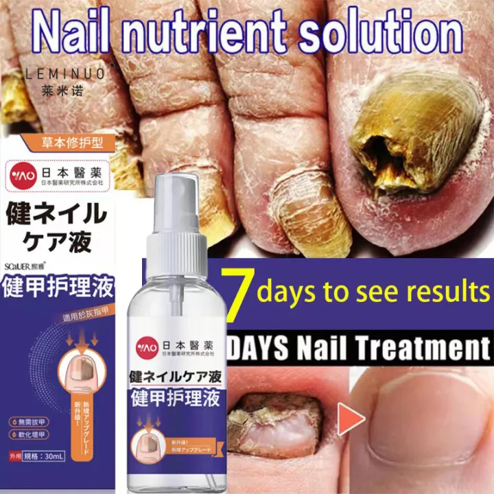 Nail Fungus Treatment Nail Repair Liquid Stop Fungal Growth Effective