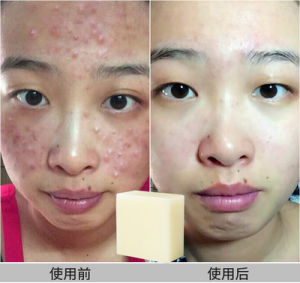 100g Original Sea Salt Soap Removal Pimple Blackhead shrink Pores Antiacne Whitening Whip Soap Goat Milk Face Wash Soap Face Wash Body Soaps Body Wash Foaming Soap Clear Mite Bath Soap Love Handmade Soap Anti Bacterial Bath Shower