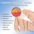 South Moon Lipoma Removal Spray lipoma cream original Relief Pain Treat Skin Swelling Lipolysis Cellulite Fat Lump Nodule Removal Ointment lipoma removal spray. 