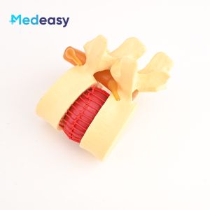 Spinal model Lumbar intervertebral disc protrusion model