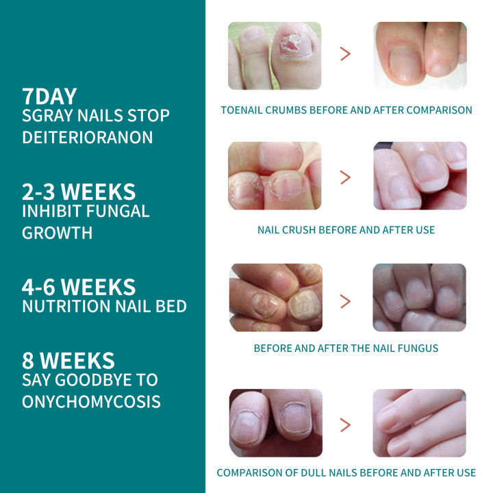 %E3%80%90100%25%20Effective%E3%80%91Jaysuing%20Fungal%20Nail%20Treatment%20Patch%20Anti%20Infection%20Paronychia%20Thickening%20Soft%20Waterproof%2032pcs%20-%20Image%206