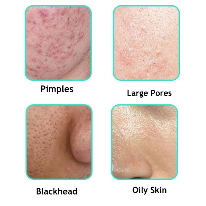 臻羞水杨酸 15% Azelaic Acid Acne & 15%壬二酸凝胶去黑头 收缩毛孔粗大改善闭口 Salicylic Acid ...