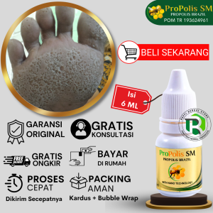 Obat Kaki Rayapan Bau Obat Pitted Keratolysis Obat Telapak Kaki Bolong Bolong Kecil Obat Kaki Pecah Dan Kering Kaki Rorombeheun Kaki Bolong2 Kaki Rinyuhan Lubang Kecil Kecil di Telapak Kaki - PROPOLIS SM 100% ASLI ORIGINAL