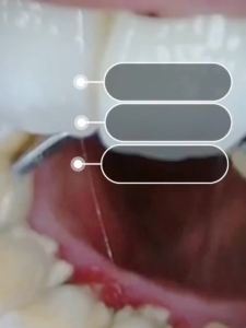 牙结石去除剂超声波洁牙器医用洗牙器牙渍去牙黄牙斑美白牙神器