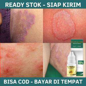 Obat Gatal Selangkangan Obat Gatal Selangkangan Pria Wanita Obat Gatal Selangkangan dan Kemaluan