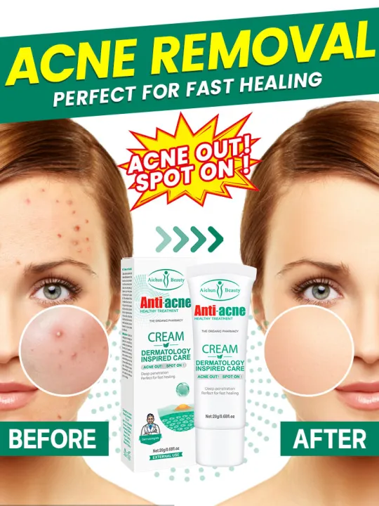 Crema facial para eliminar cicatrices de acné, tratamiento de belleza Aichun, crema antiacné para el cuidado de la piel, crema para los poros