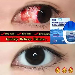 Obat tetes mata Tetes Mata Herbal Tetes Mata Alami eye drop Mengandung ekstrak blueberry Mata kering Sakit mata Darah Merah Ketegangan mata Mata gatal Minus Gatal Merah Belekan dan Berair Glukoma Glaukoma Akut Katarak Penglihatan Buram 15ml