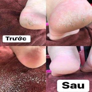 [GIÁ TỐT] Bộ chà gót chân bằng tay chuyên dụng (cây chà bằng inox + kem mềm da)